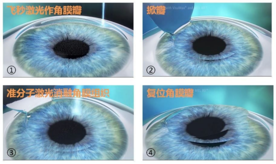 半飞秒激光近视手术如何选择手术设备一文读懂